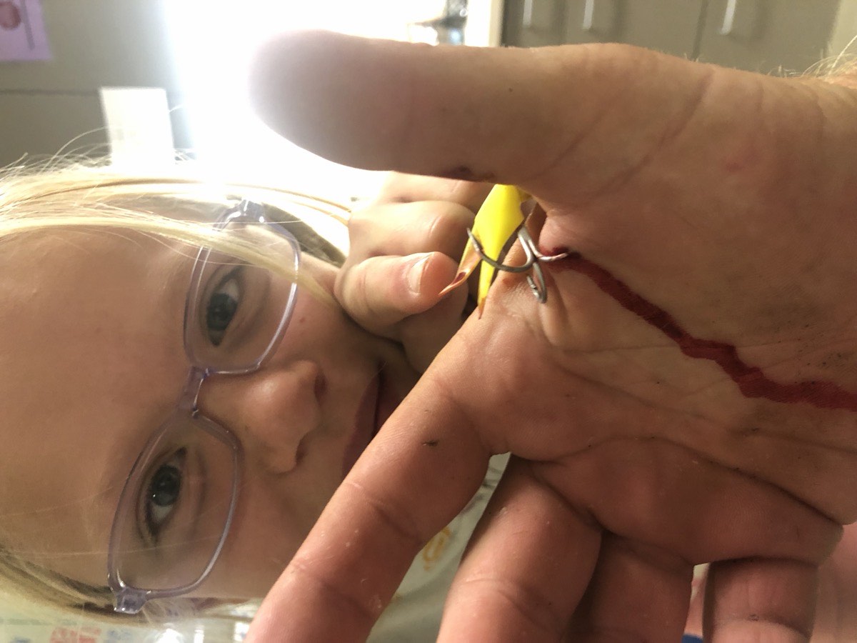 A treble fishhook stuck in Tom Skinner's hand while his daughter Courtney looks on